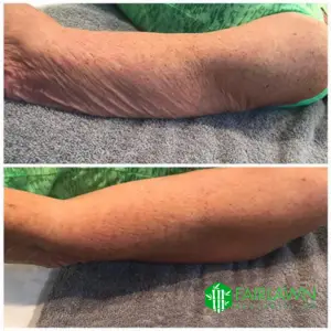 fat loss akron ohio