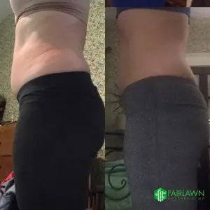 Emsculpt Cleveland