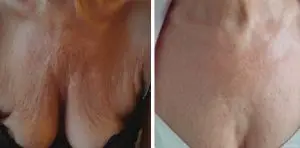before after picture skin resurfacing chest