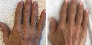 before and after pictures IPL photorejuvination