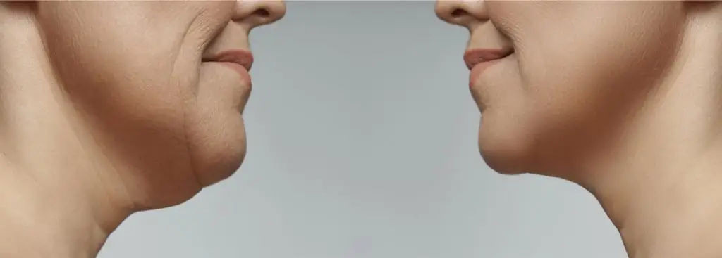 double chin removal