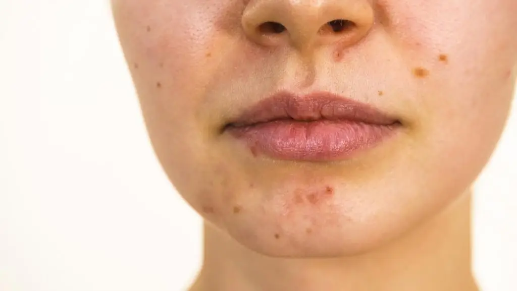 Young woman showing her face with acne and moles, dry lips. Teen girl no make up with red spots on her chin. Health problem, skin diseases.