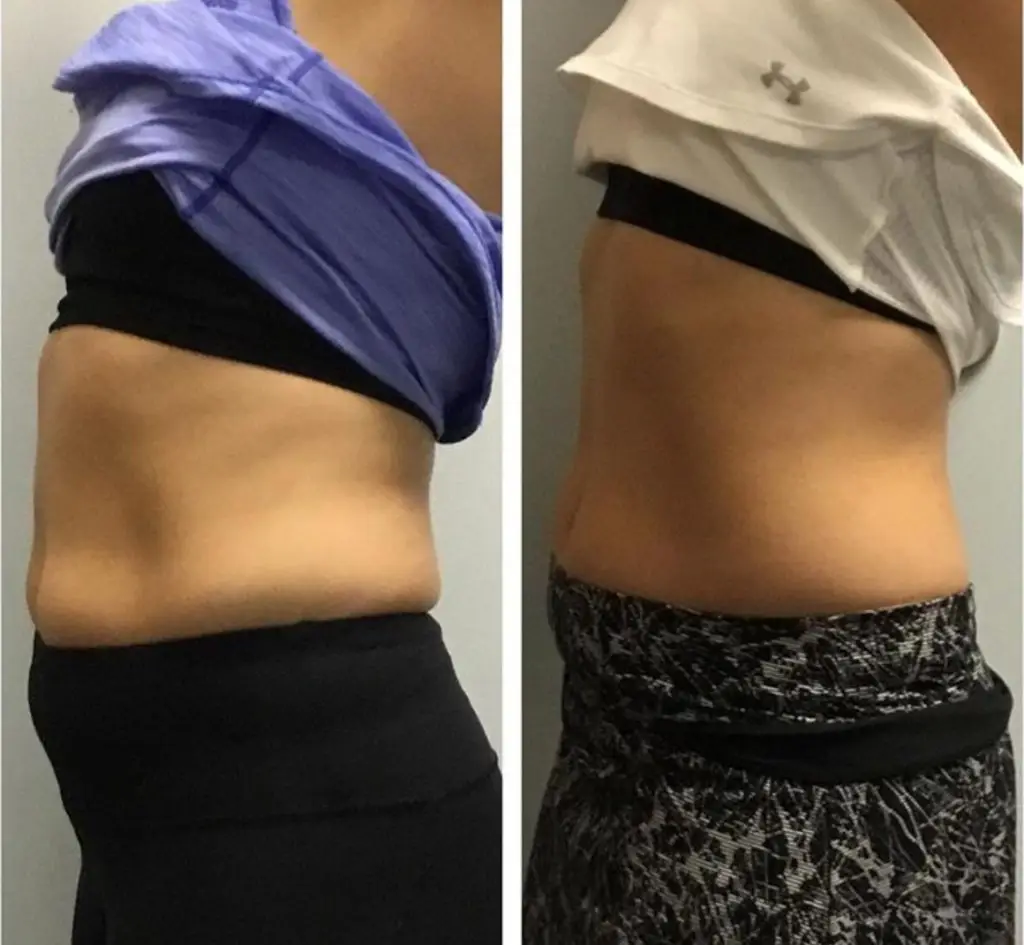 Before and After Cryo T-Shock Stomach