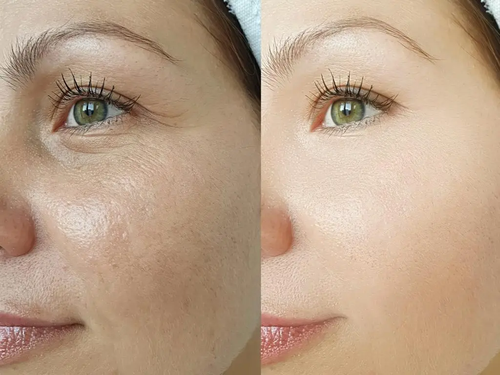 woman face wrinkles before and after treatment