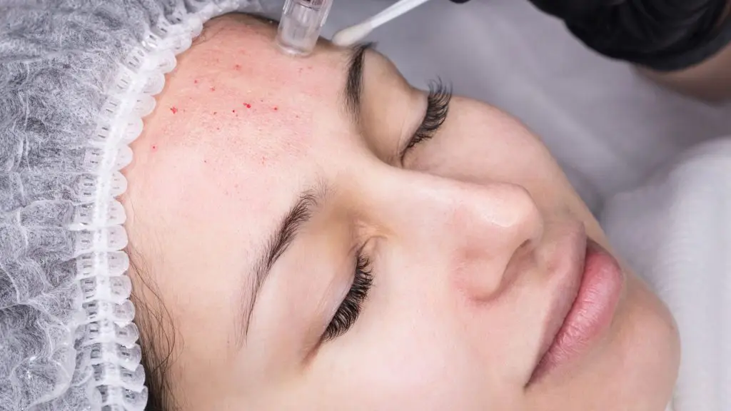 micro needle mesotherapy, dermal pen