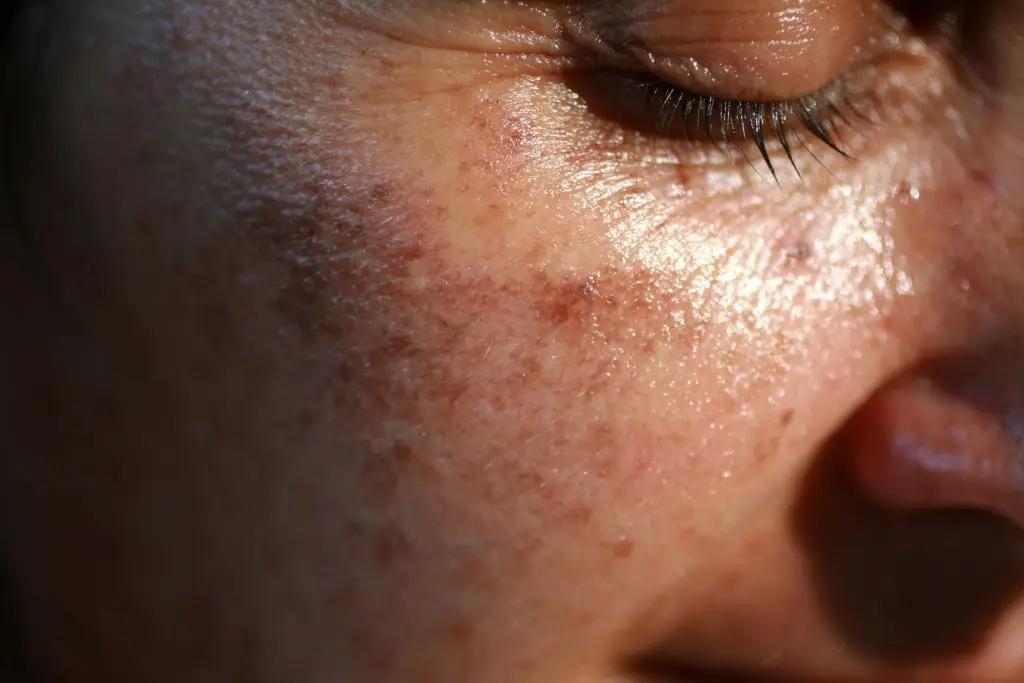 pigmented spots on face and cheek, sunspots