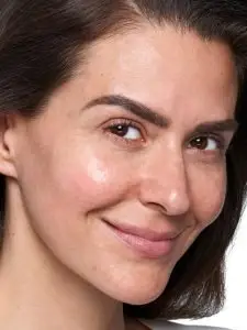 after skinvive treatment
