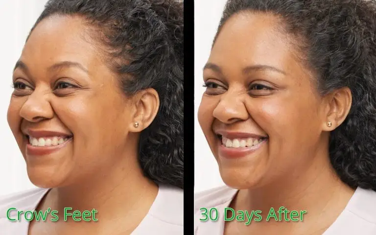 Crow's feet treatment before and 30 days after