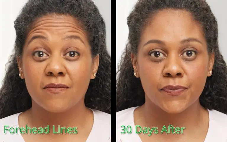 Forehead lines treatment before and 30 days after