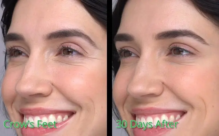 Crow's feet treatment before and 30 days after