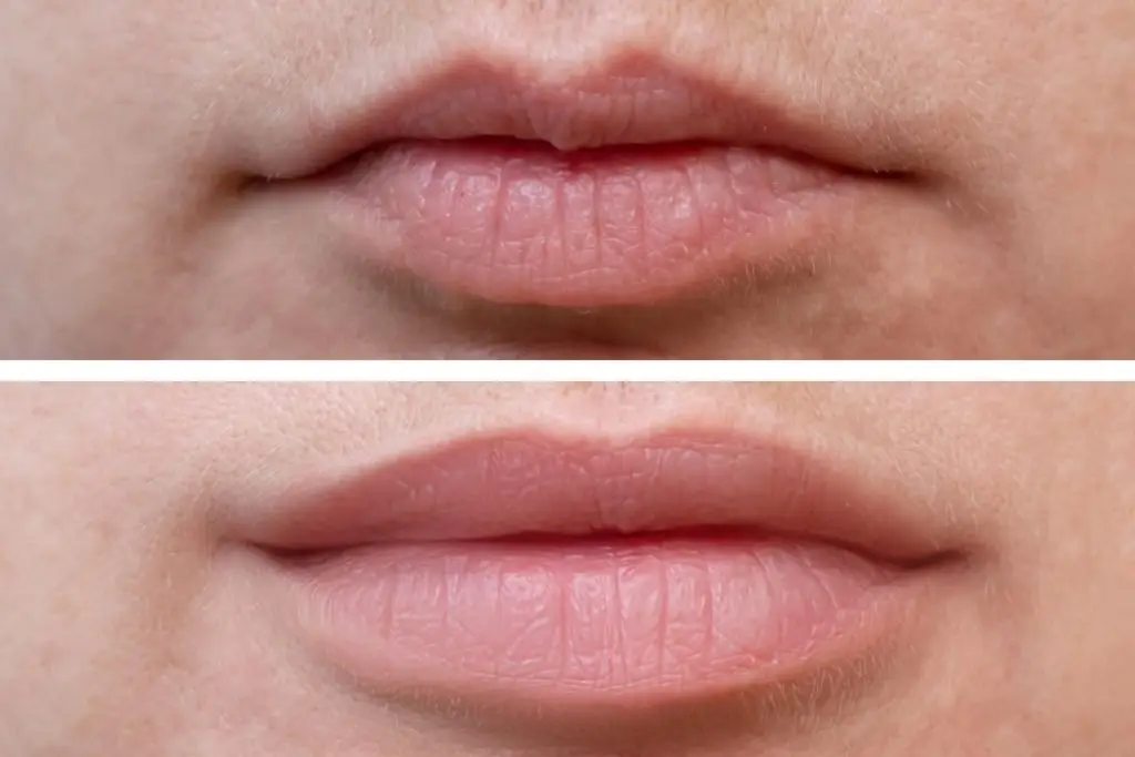 Female lips before and after augmentation, the result of using hyaluronic filler