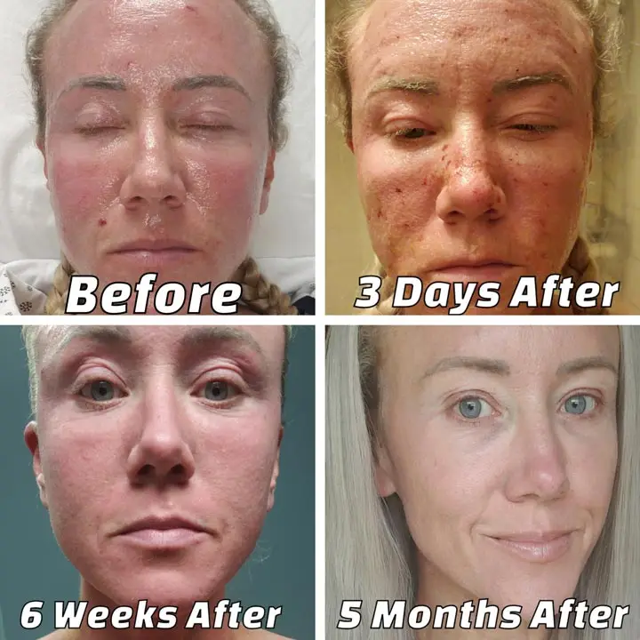 co2 fractional laser before and after results