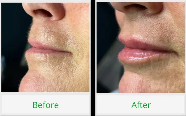 lip filler before and after