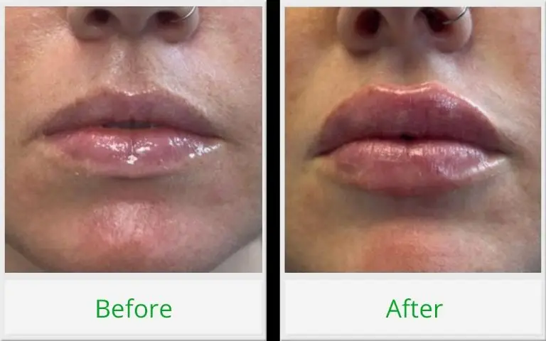 lip filler before and after