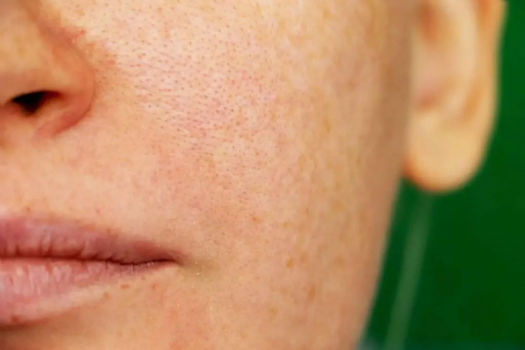 closeup of face with problem skin